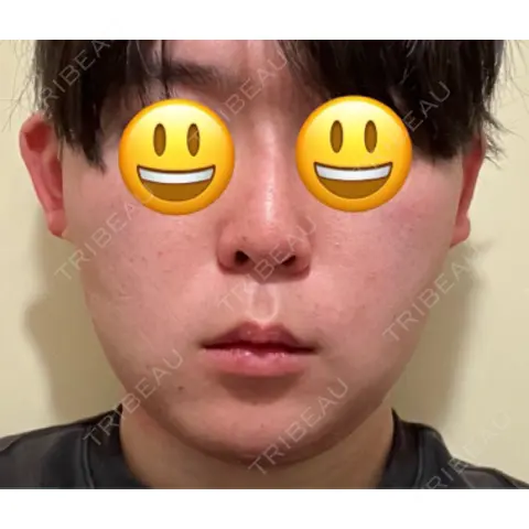 糸リフト / バッカルファット除去 / 脂肪吸引（顔） / メーラーファット除去 / ジョールファット除去 / ボトックス（エラ・小顔） アリエル美容クリニック 大宮院 DAY 0
