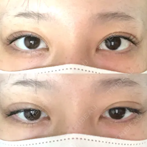 二重埋没 BELINDA CLINIC（ベリンダクリニック）新宿院 AFTER
