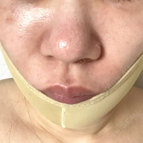 クマ治療 / 脂肪吸引（顔） / ジョールファット除去 R Beauty CLINIC 大阪院 DAY 0