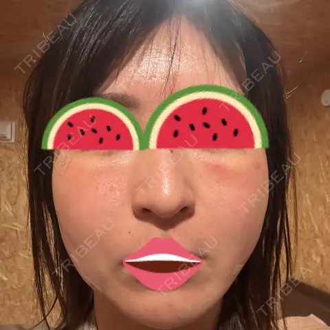 脂肪注入（肌） eクリニック 新宿院 DAY 1