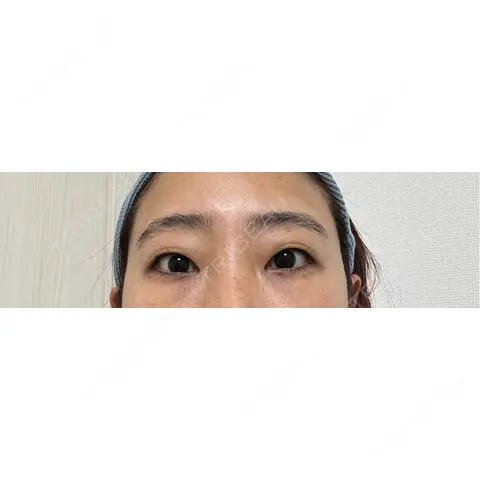 クマ治療 / 下まぶたたるみ取り / 下まぶたの脂肪取り / 脂肪注入（輪郭） 東京シンデレラ美容外科 池袋院 AFTER