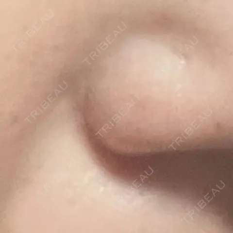 ヒアルロン酸注入（鼻翼基部） 日比谷セントラルクリニック AFTER