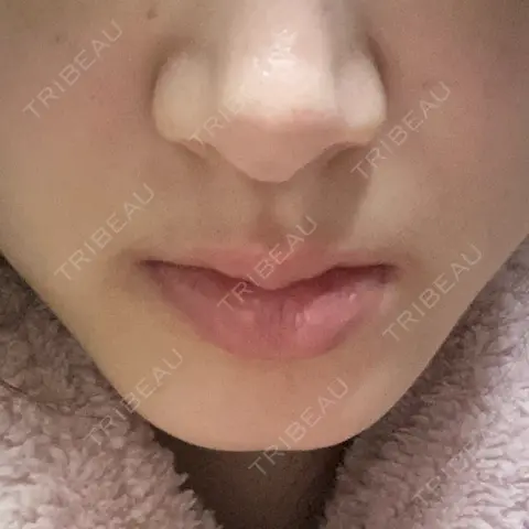 ボトックス（あご） / ボトックス（口角） / シワ取りボトックス / ボトックス（人中） / ボトックス（ガミースマイル） LE CLINIC AFTER