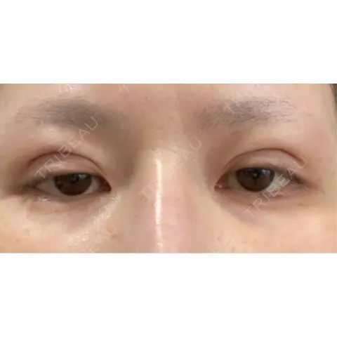 二重埋没 WOM CLINIC GINZA （ワム クリニック ギンザ） DAY 0