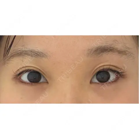 目尻切開 / タレ目形成・グラマラスライン（埋没） LOUIS CLINIC 二子玉川院【ルイクリニック】 AFTER