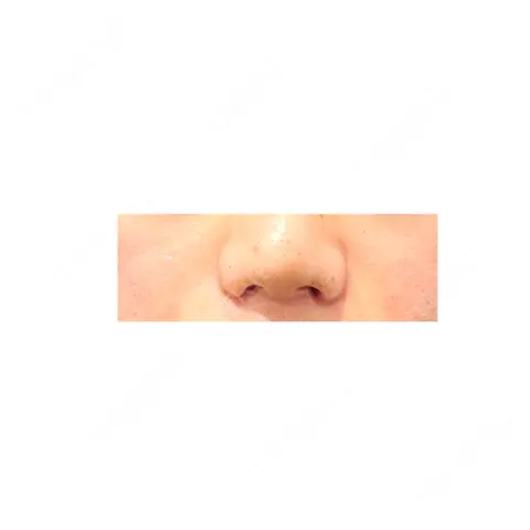 鼻尖形成（切開） / 鼻中隔延長（切開） / 小鼻縮小（切開） / 軟骨移植 R Beauty CLINIC 大阪院 DAY 8