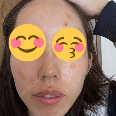 ほくろ・いぼ切除（肌） KARIS beauty clinic DAY 0