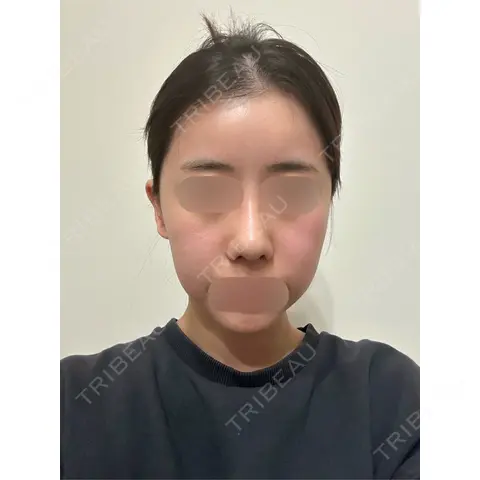 隆鼻術 / 鼻尖形成（切開） / 鼻中隔延長（切開） / 小鼻縮小（切開） / 骨切り（あご） / 骨削り（エラ） / 骨削り（頬） / 骨切幅寄せ セギム美容整形外科 DAY 95