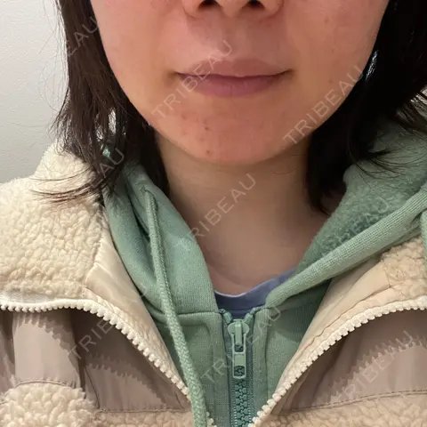 RF（高周波）たるみ治療 RIVER CLINIC（リバークリニック） DAY 1