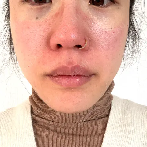 糸リフト / クマ治療 / 下まぶたの脂肪取り LE CLINIC DAY 0