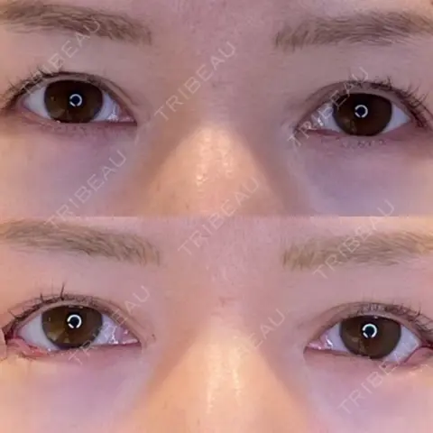 目尻切開 / タレ目形成・グラマラスライン（埋没） LOUIS CLINIC 二子玉川院【ルイクリニック】 DAY 0