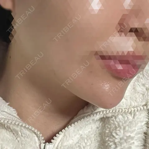 ヒアルロン酸注入（あご） 共立美容外科 梅田院 AFTER