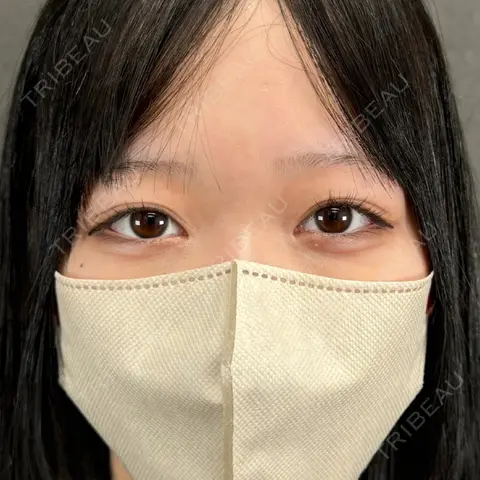 目頭切開 ネビュラクリニック 京都院 AFTER