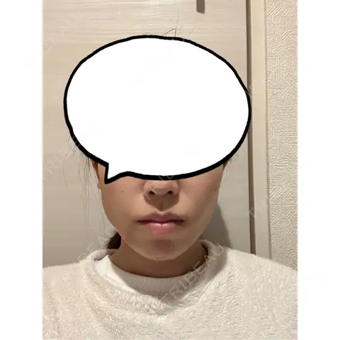 糸リフト / 脂肪吸引（顔） / 脂肪吸引（二の腕） / 脂肪吸引（肩） / ボトックス（エラ・小顔） / ボトックス（肩） ヴェルトラクリニック 大阪院 DAY 1