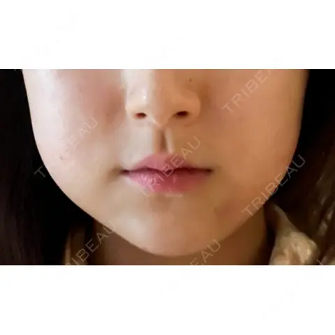 RF（高周波）たるみ治療 BISIN GINZA CLINIC DAY 1
