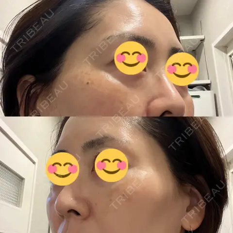 美容点滴・美容注射（美肌） / 白玉点滴・注射 / 美肌レーザー / シミ取りレーザー / 美白レーザー / ピコレーザートーニング（美白・肝斑） / レーザートーニング（美白・肝斑） / レーザーフェイシャル LE CLINIC AFTER