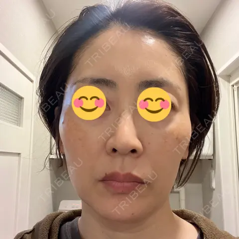 美容点滴・美容注射（美肌） / 白玉点滴・注射 / 美肌レーザー / シミ取りレーザー / 美白レーザー / ピコレーザートーニング（美白・肝斑） / レーザートーニング（美白・肝斑） / レーザーフェイシャル LE CLINIC AFTER