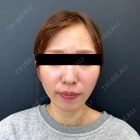 糸リフト / バッカルファット除去 / 脂肪吸引（顔） BLINC CLINIC （ブリンク クリニック） AFTER