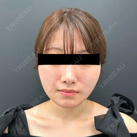 糸リフト / バッカルファット除去 / メーラーファット除去 / ジョールファット除去 BLINC CLINIC （ブリンク クリニック） AFTER