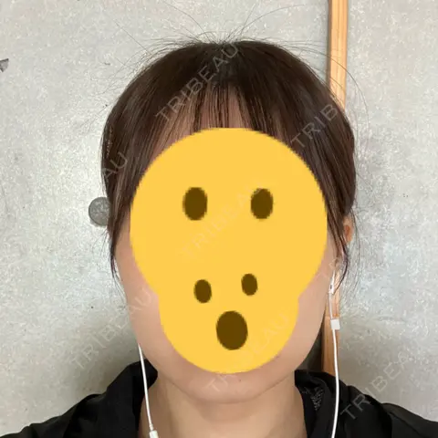 ボトックス（エラ・小顔） KARIS beauty clinic DAY 1