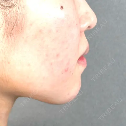 糸リフト アリエル美容クリニック 大宮院 DAY 0