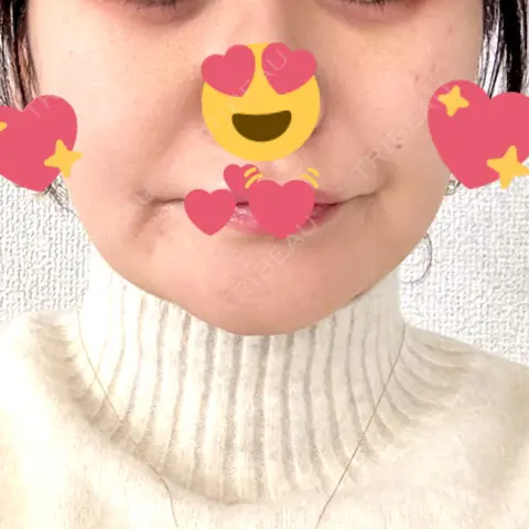 ピコレーザートーニング（美白・肝斑） / ピコスポット おおかみ美容のクリニック 新宿院 DAY 0