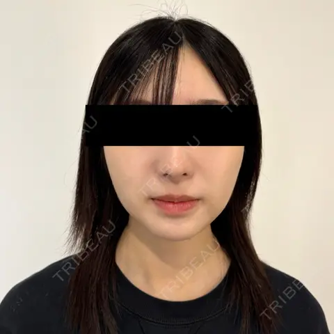 糸リフト / 脂肪吸引（顔） / ジョールファット除去 / 脂肪吸引注射（顔） SEA CLINIC（シークリニック） DAY 70