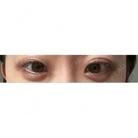 二重埋没 THE FIRST CLINIC 多摩センター院 AFTER