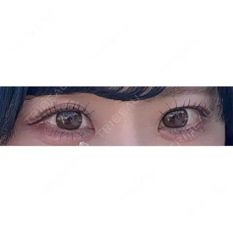 二重埋没 THE FIRST CLINIC 多摩センター院 AFTER