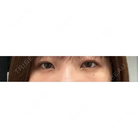 クマ治療 / 下まぶたの脂肪取り / ヒアルロン酸注入（唇） / ヒアルロン酸注入（目の下） / その他（目元） ROOTS Clinic AFTER