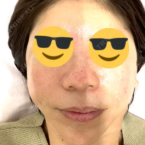 マイクロボトックス ルラ美容クリニック 千葉院 DAY 0