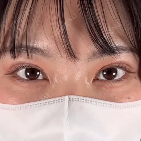 二重埋没 TCB東京中央美容外科 高崎院 AFTER