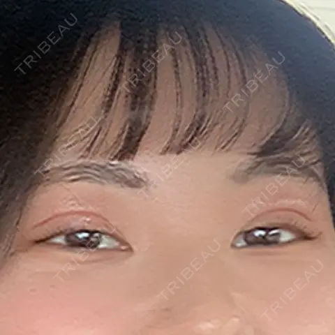 二重埋没 TCB東京中央美容外科 高崎院 AFTER