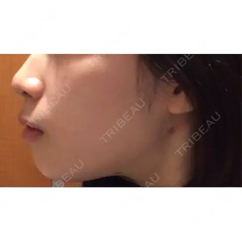 脂肪吸引（顔） / 脂肪吸引注射（顔） ziz CLINIC DAY 0