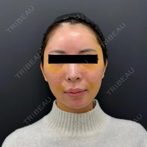 糸リフト / バッカルファット除去 / 脂肪吸引（顔） / メーラーファット除去 / その他（輪郭） BLINC CLINIC （ブリンク クリニック） DAY 7