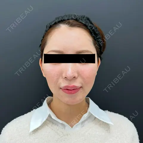 糸リフト / バッカルファット除去 / 脂肪吸引（顔） / メーラーファット除去 / その他（輪郭） BLINC CLINIC （ブリンク クリニック） AFTER