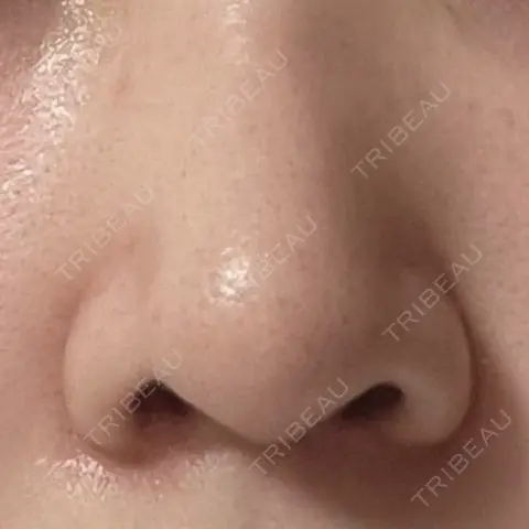 鼻尖形成（切開） / 鼻中隔延長（切開） / 小鼻縮小（切開） / 骨切幅寄せ / ワシ鼻修正・ハンプ切除 セギム美容整形外科 DAY 92