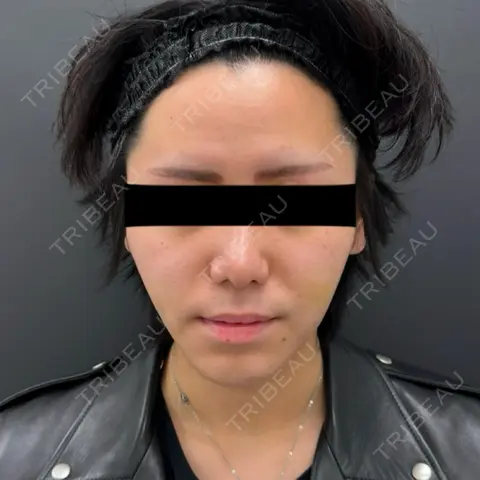 メーラーファット除去 BLINC CLINIC （ブリンク クリニック） DAY 8