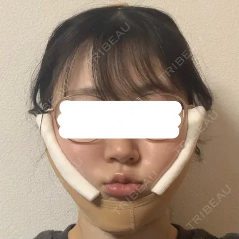 糸リフト / 脂肪吸引（顔） / 脂肪注入（額） / ジョールファット除去 / 脂肪吸引注射（顔） SEA CLINIC（シークリニック） DAY 0