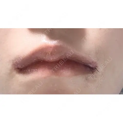 口角挙上 くさのたろうクリニック AFTER