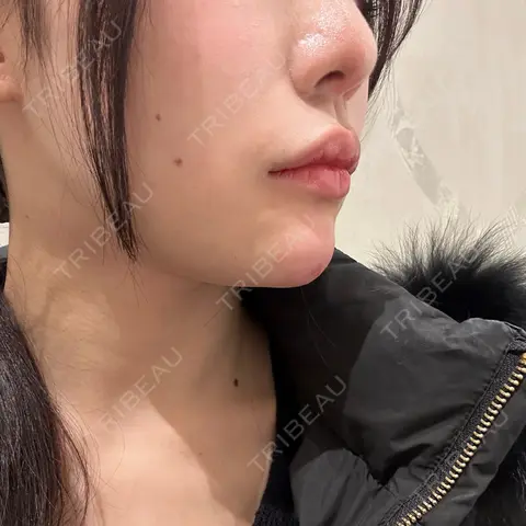 ボトックス（あご） / ヒアルロン酸注入（あご） 銀座みゆき通り美容外科 大阪梅田院 DAY 0