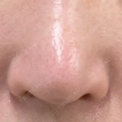 鼻尖形成（切開） / 軟骨移植 / 鼻孔縁下降 / 鼻柱下降・鼻唇角形成（猫手術） もとび美容外科クリニック 新宿院 AFTER