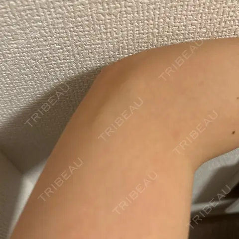 プラセンタ注射 城本クリニック 新宿院 AFTER