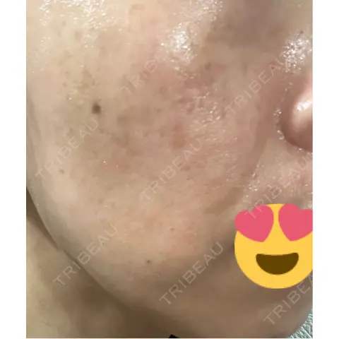 ルメッカ ルラ美容クリニック 札幌院 AFTER
