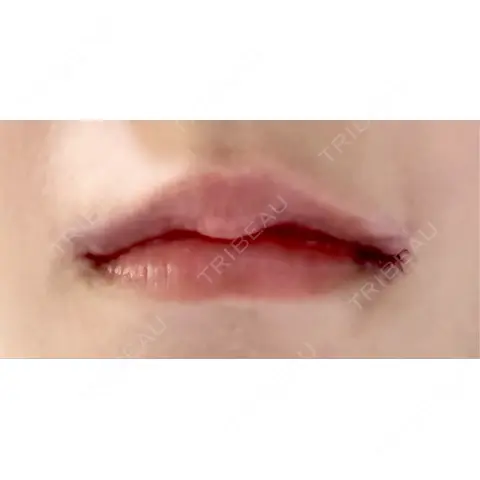 口角挙上 くさのたろうクリニック AFTER