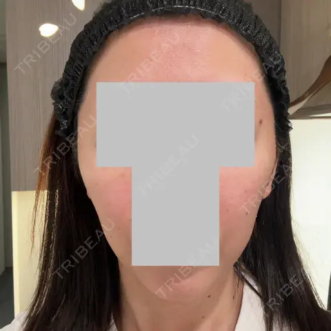 RF（高周波）たるみ治療 LUNA BEAUTY CLINIC 池袋駅前院 DAY 0