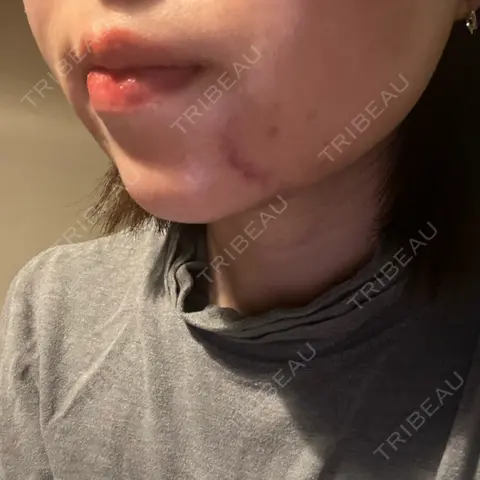RF（高周波）たるみ治療 BISIN GINZA CLINIC AFTER