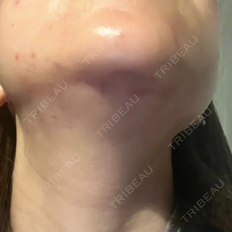 RF（高周波）たるみ治療 BISIN GINZA CLINIC AFTER