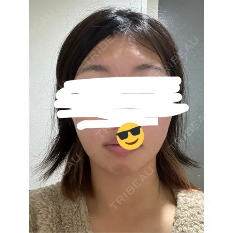 RF（高周波）たるみ治療 / その他（鼻） ルラ美容クリニック 千葉院 DAY 0