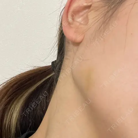 ボトックス（エラ・小顔） TCB東京中央美容外科 大分院 AFTER